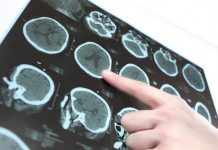 Is there any relation between brain supplement and alzheimer’s? Is there any relation between brain supplement and alzheimer's?