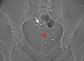 Woman's 'missing' IUD turns up in her bladder (Report)