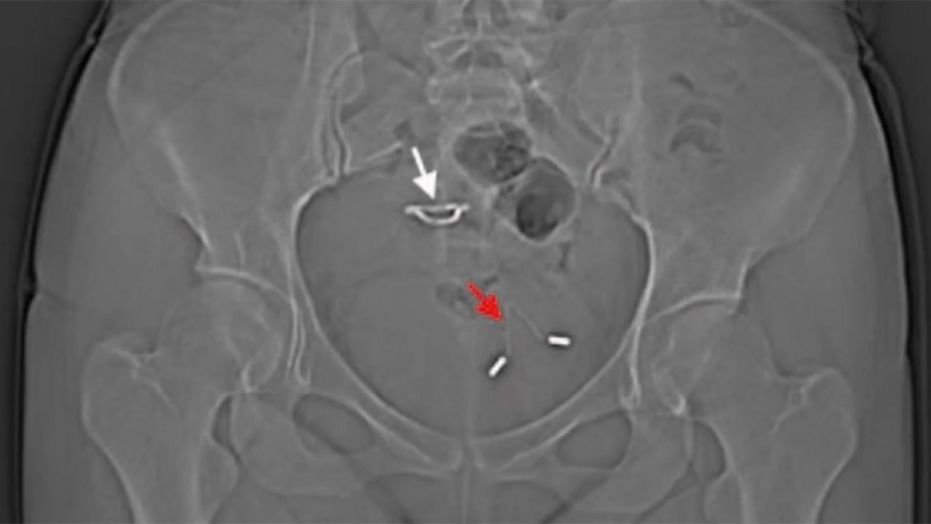 The red arrow points to the IUD in the bladder, while the white arrow points to a second IUD inserted in the uterus.
