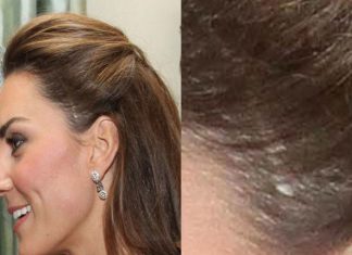 Kate Middleton: The reason why the Duchess of Cambridge has a scar | Royal | News (Details)