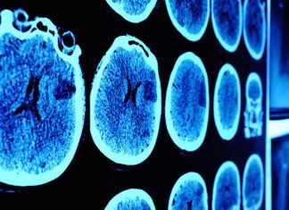 AI Alzheimer’s disease: scientists develop AI tool to help support clinicians AI Alzheimer's disease: scientists develop AI tool to help support clinicians