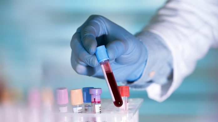 Blood Test Might Show Early Warning of Alzheimer's disease