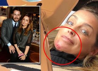 Louise Redknapp shocking injury pictures, Report Louise Redknapp shocking injury pictures, Report