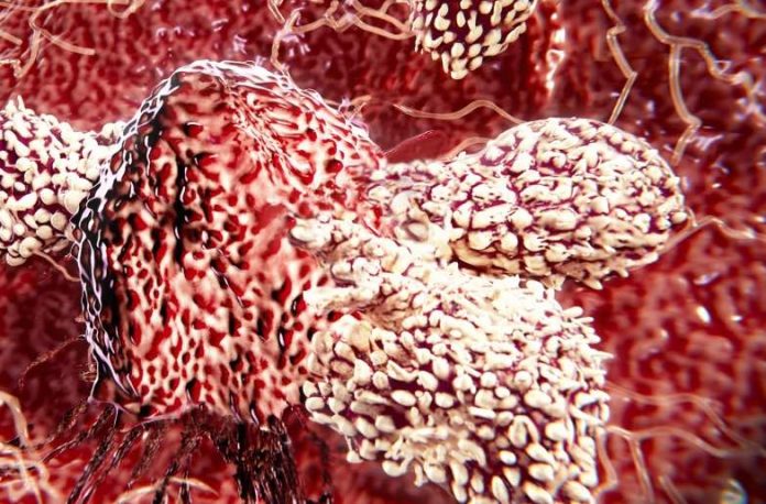 Immune cell which kills most cancers discovered, Report