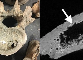 Study: Cancer rates in medieval Britain were around ten times higher than previously thought Study: Cancer rates in medieval Britain were around ten times higher than previously thought