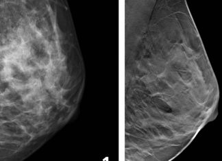 Study: Fewer breast cancer cases between screening rounds with 3D-mammography Study: Fewer breast cancer cases between screening rounds with 3D-mammography