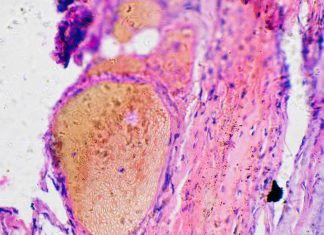 Study: Predicting Mutated Gene Associated With Melanoma Study: Predicting Mutated Gene Associated With Melanoma