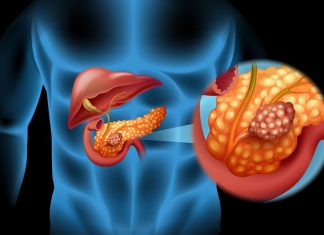 Pancreatic cancer trials fail to include minorities despite worse outcomes, says study Pancreatic cancer trials fail to include minorities despite worse outcomes, says study