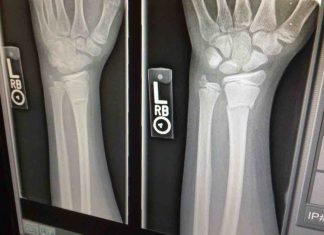 Study: Even fractures in arm, wrist increase risk for future breaks in postmenopausal women Study: Even fractures in arm, wrist increase risk for future breaks in postmenopausal women