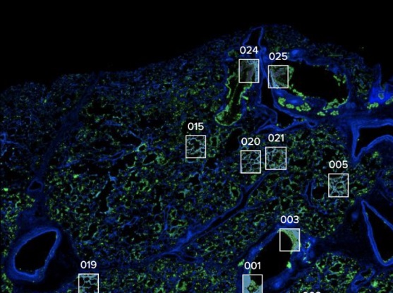 Study: Large collaboration creates cell atlas of COVID-19 pathology