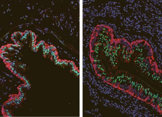 Study: Molecular analysis identifies key differences in lungs of cystic fibrosis patients Study: Molecular analysis identifies key differences in lungs of cystic fibrosis patients