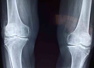 Study: New map reveals genes that control the skeleton Study: New map reveals genes that control the skeleton