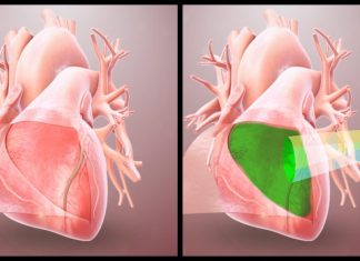 Bio-inspired hydrogel protects the heart from post-op adhesions, says study Bio-inspired hydrogel protects the heart from post-op adhesions, says study