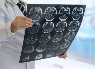 Study: A small chip under the skin may predict second stroke Study: A small chip under the skin may predict second stroke