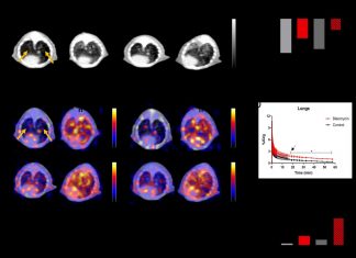 Study: Radiotracer effective for detection and assessment of lung fibrosis Study: Radiotracer effective for detection and assessment of lung fibrosis