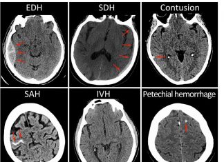 Research shows imaging after mild brain injury may predict outcomes Research shows imaging after mild brain injury may predict outcomes