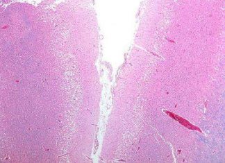 For the first time, stroke research reveals optimal timing and intensity for arm and hand rehabilitation For the first time, stroke research reveals optimal timing and intensity for arm and hand rehabilitation