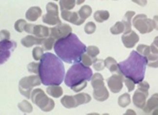 Researchers discover a fundamental feature of aggressive lymphomas Researchers discover a fundamental feature of aggressive lymphomas