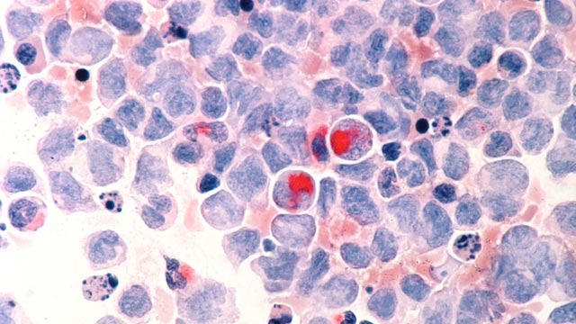 Study: Improving leukemia therapy with targeted treatment approaches