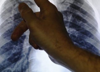 Tuberculosis programs should focus more on young people, says study Tuberculosis programs should focus more on young people, says study