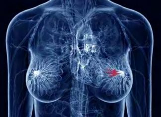 Armidex found to cut breast cancer risk in half for postmenopausal women Armidex found to cut breast cancer risk in half for postmenopausal women