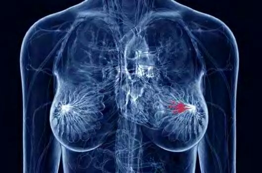 Armidex found to cut breast cancer risk in half for postmenopausal women