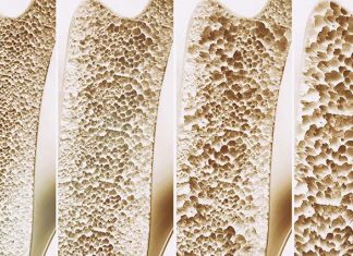 Osteoporosis screening guidelines flawed for younger postmenopausal women Osteoporosis screening guidelines flawed for younger postmenopausal women