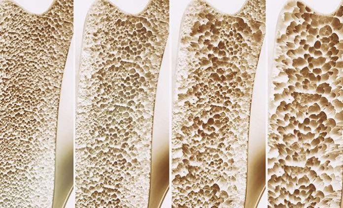 Osteoporosis screening guidelines flawed for younger postmenopausal women
