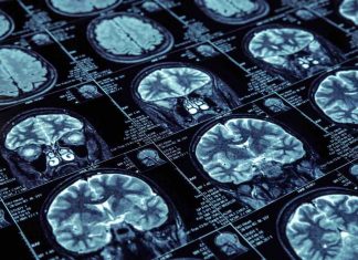 Slowing down brain shrinkage from high blood sugar levels and insulin resistance Slowing down brain shrinkage from high blood sugar levels and insulin resistance