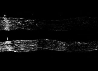 Study: Do-It-Yourself artificial pancreas given approval by team of experts Study: Do-It-Yourself artificial pancreas given approval by team of experts