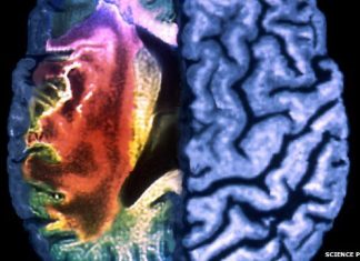 Stanford Stem Cell Research Reveals Promise for Stroke Patients Stanford Stem Cell Research Reveals Promise for Stroke Patients