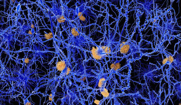 Study shows no Alzheimer’s drug in near future
