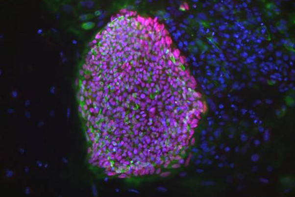 Treating diabetes via embryonic cloning holds promise