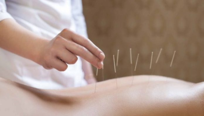 Acupuncture may help to reduce hot flashes
