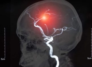 Study: Novel treatment effective for sidewall brain aneurysm Study: Novel treatment effective for sidewall brain aneurysm