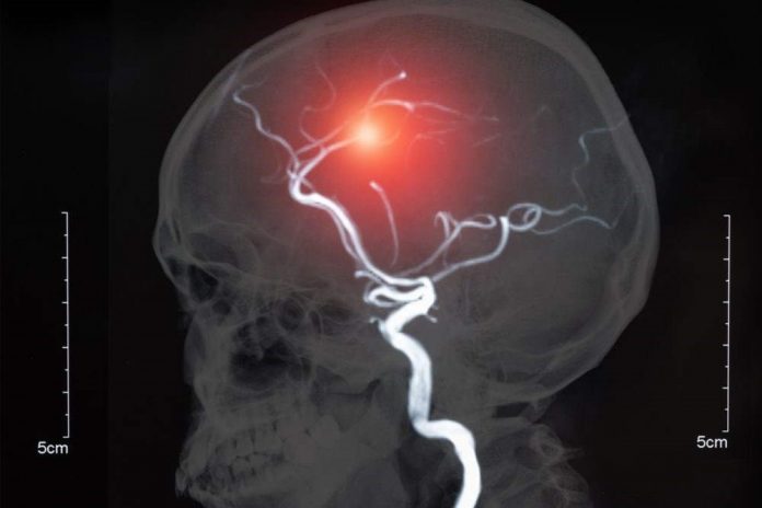 Study: Novel treatment effective for sidewall brain aneurysm