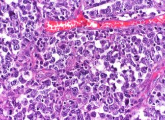 New research reveals cause, potential precision therapies for aggressive type of lymphoma New research reveals cause, potential precision therapies for aggressive type of lymphoma