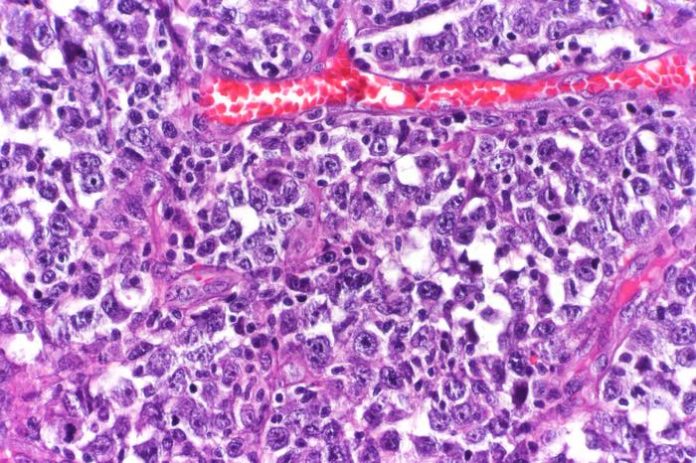 New research reveals cause, potential precision therapies for aggressive type of lymphoma