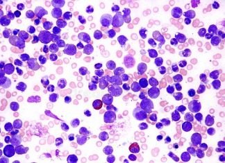 Study: New effective combination therapy for paediatric T-acute leukaemia Study: New effective combination therapy for paediatric T-acute leukaemia