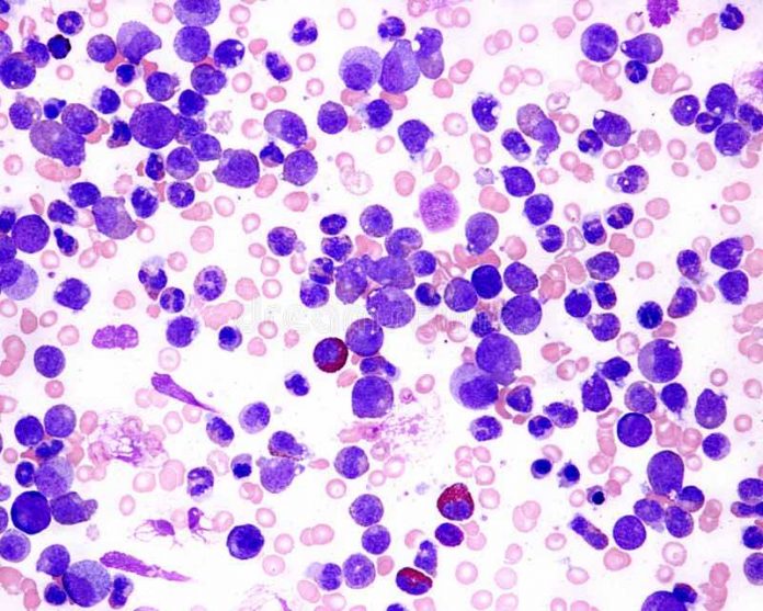 Study: New effective combination therapy for paediatric T-acute leukaemia