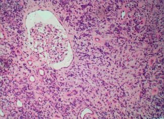 New blood test helps in identifying cause of MGN kidney disease New blood test helps in identifying cause of MGN kidney disease
