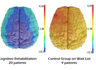 Cognitive difficulties due to breast cancer treatment are treatable Cognitive difficulties due to breast cancer treatment are treatable