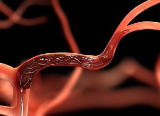 New clot retrieval device greatly improves stroke outcomes New clot retrieval device greatly improves stroke outcomes