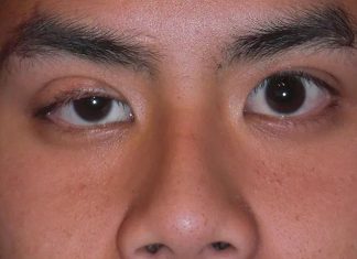 Myasthenia gravis associated with psychiatric symptoms Myasthenia gravis associated with psychiatric symptoms