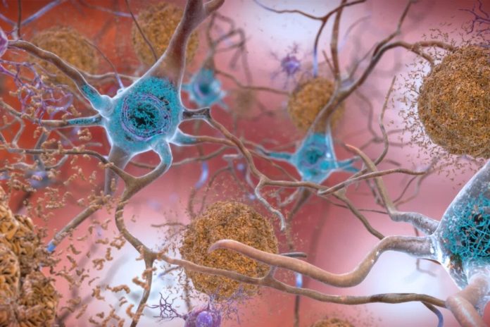 New research points to tau protein malfunction as cause of Alzheimer’s
