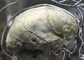 New study confirms throat bacteria link to schizophrenia New study confirms throat bacteria link to schizophrenia