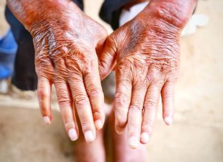 Scleroderma may cause psychiatric symptoms, studies suggest Scleroderma may cause psychiatric symptoms, studies suggest