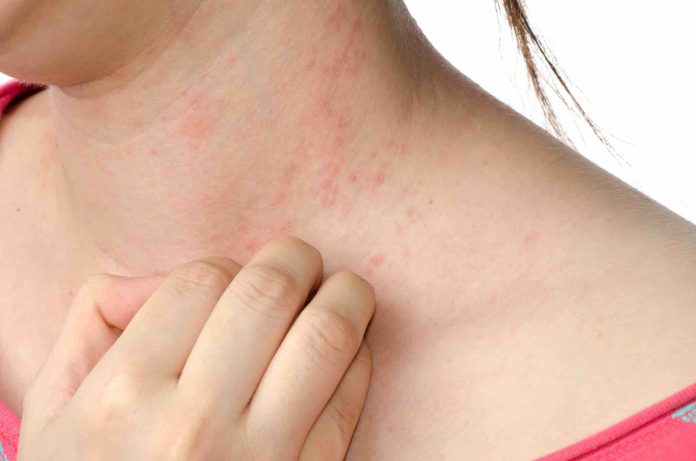 Serotonin receptor discovery may end eczema itch