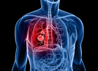 Iressa approved as first-line treatment in war against mestastic lung cancer Iressa approved as first-line treatment in war against mestastic lung cancer