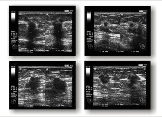 New breast cancer vaccine shows promise as an alternative to chemotherapy New breast cancer vaccine shows promise as an alternative to chemotherapy